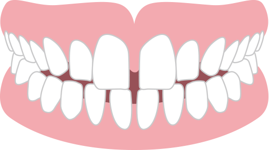 すきっ歯 空隙歯列