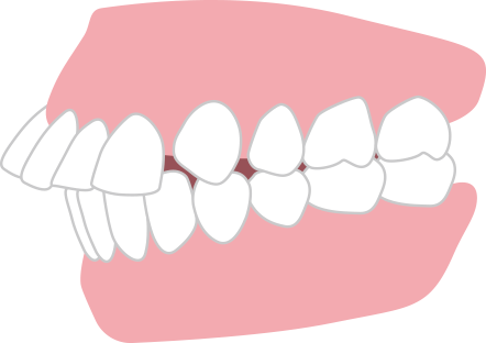 出っ歯 上顎前突・上下顎前突
