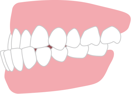 受け口 反対咬合・下顎前突