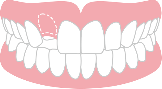 歯が出てこない 埋伏歯