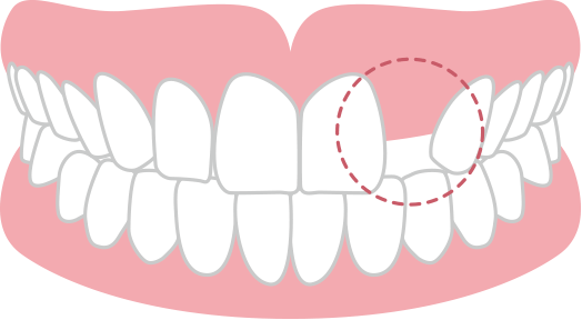 永久歯の数が少ない 先天性欠如