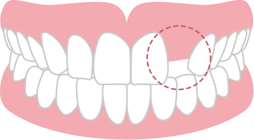 生まれつき永久歯が足りない 先天性欠如
