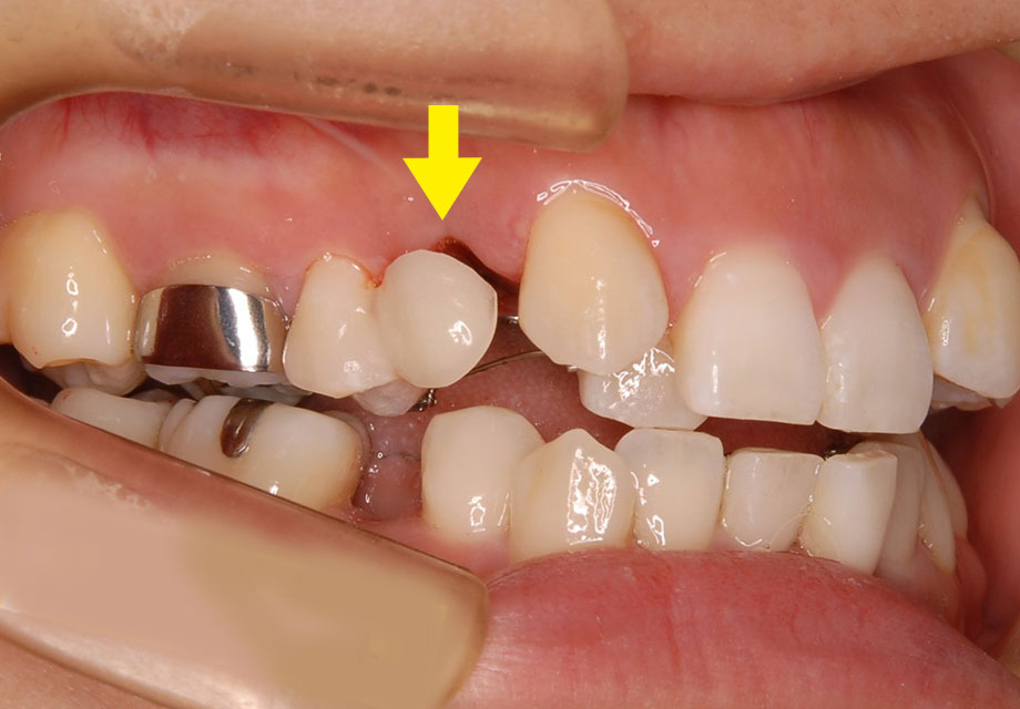 歯を抜いた部分はすき間が閉じるまでダミーの歯ですき間を隠します