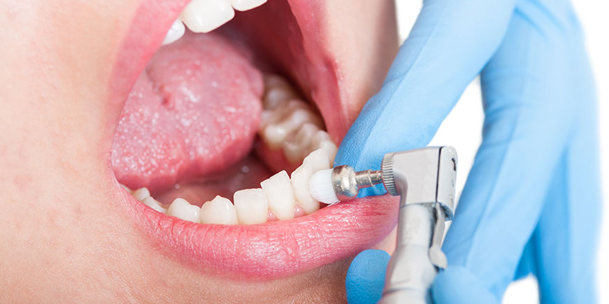 PMTC：Professional Mechanical Tooth Cleaning
